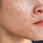 acne on face before treatment
