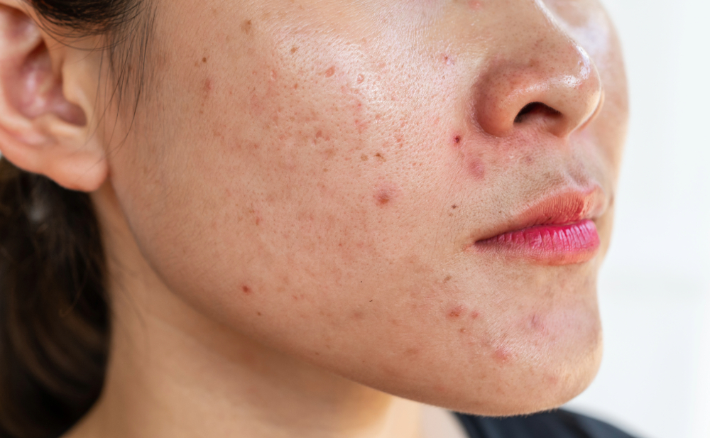 acne on face before treatment